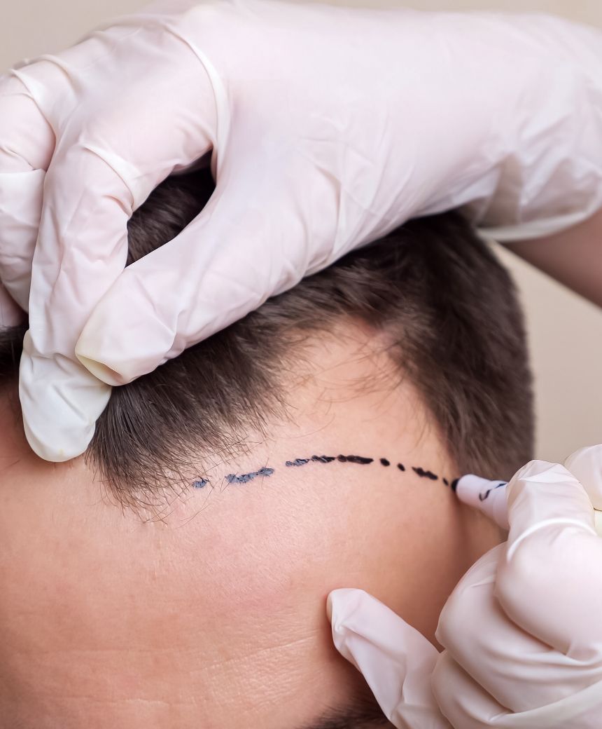 Correção de Outros Transplantes Correção de Outros Transplantes